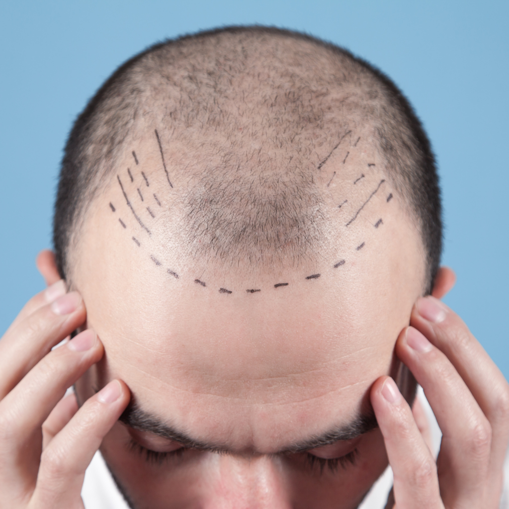 MALE HAIR TRANSPLANTATION_