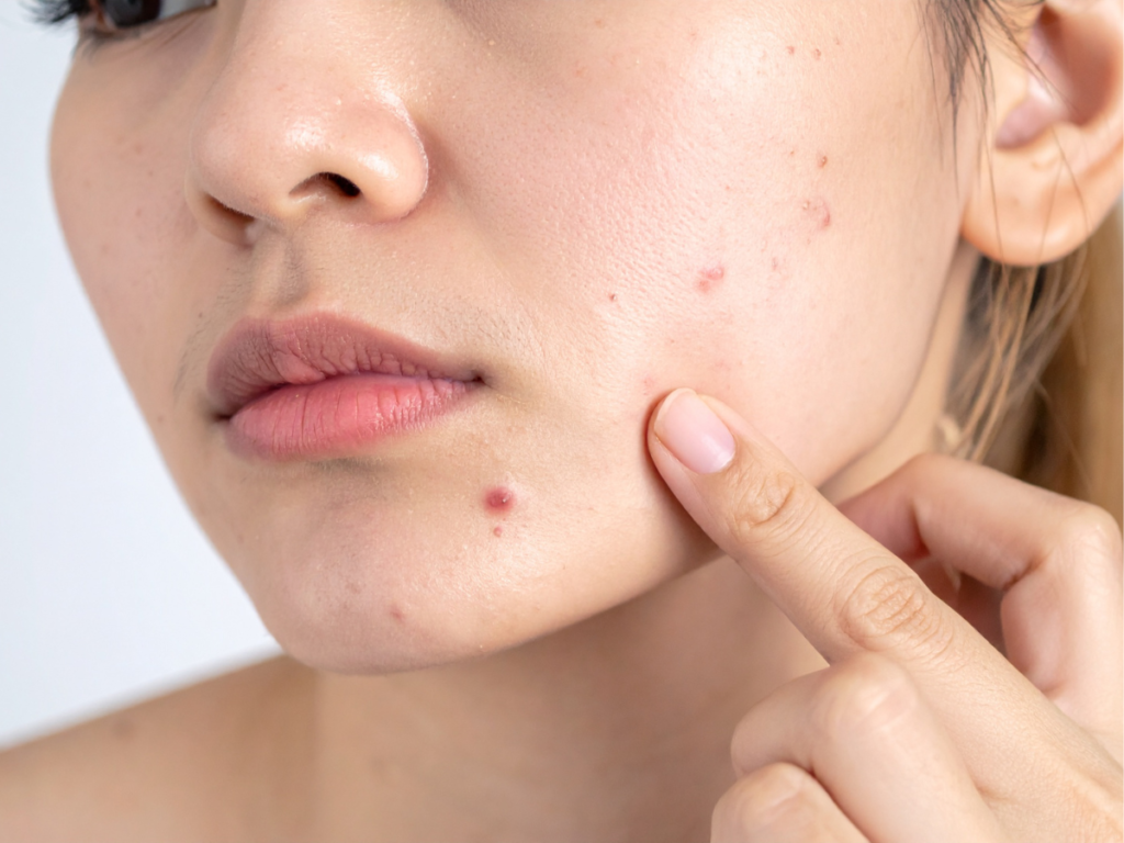 are skin tags contagious