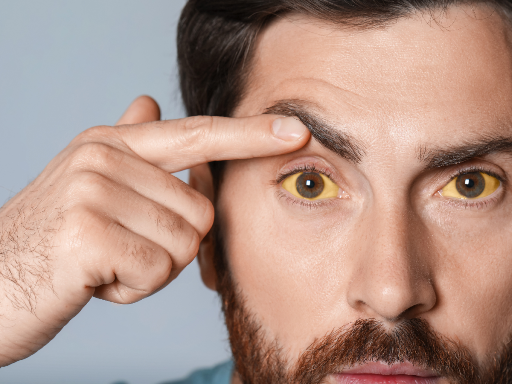 is jaundice contagious