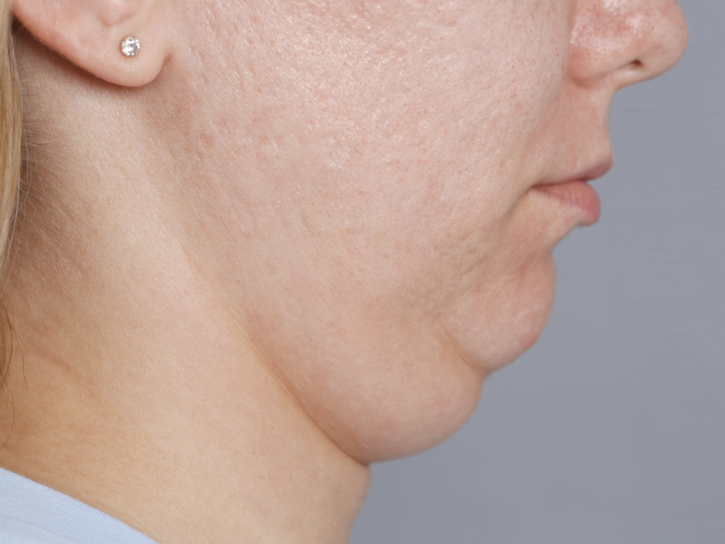 how to reduce double chin fat