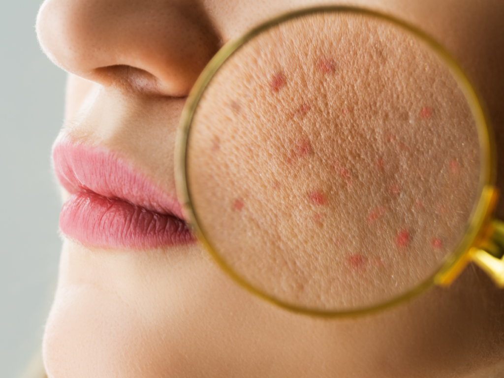 Why Do Skin Tags Form?